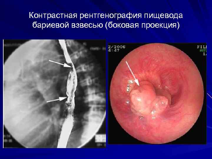 Контрастная рентгенография пищевода бариевой взвесью (боковая проекция) 