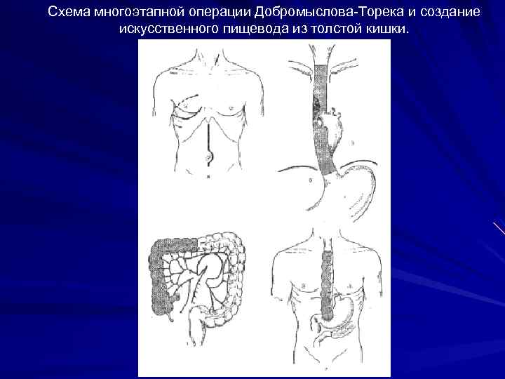 Операция льюиса схема