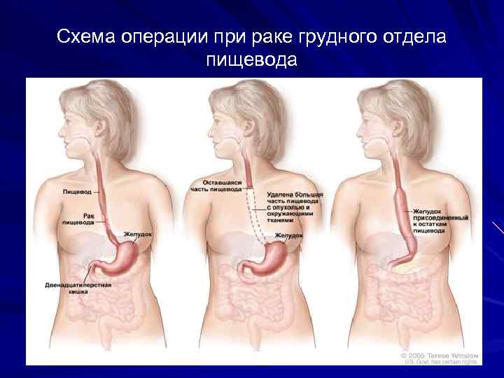 Схема операции при раке грудного отдела пищевода 