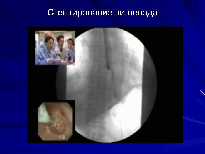 Стентирование пищевода 