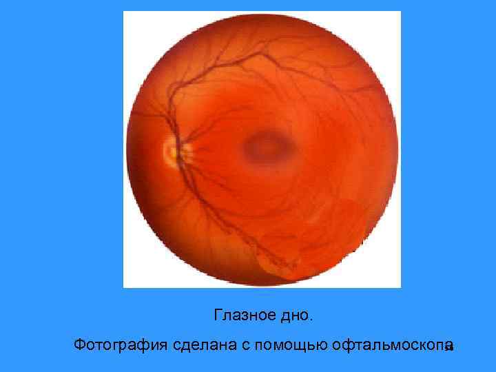 Глазное дно. Фотография сделана с помощью офтальмоскопа 36 