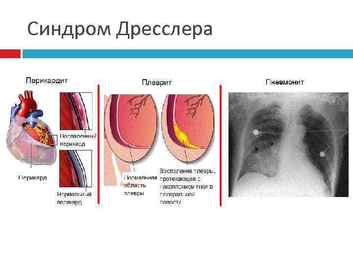 Синдром Дресслера 