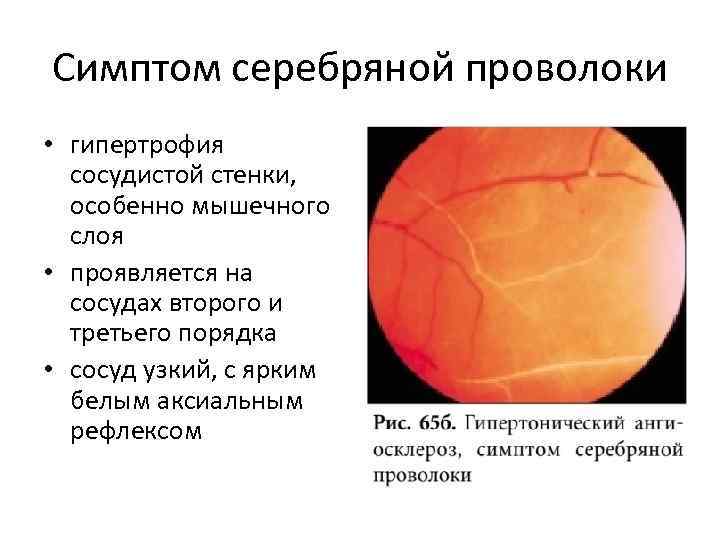 Симптом серебряной проволоки • гипертрофия сосудистой стенки, особенно мышечного слоя • проявляется на сосудах