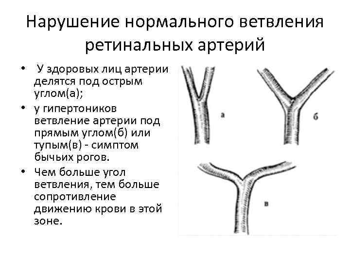 Под острым. Нарушение нормального ветвления ретинальных артерий. Магистральный Тип ветвления артерий. Типы ветвления артерий в различных органах. Тип ветвления почечной артерии.