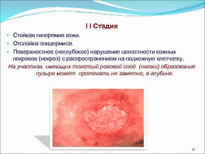 I I Стадия • Стойкая гиперемия кожи. • Отслойка эпидермиса. • Поверхностное (неглубокое) нарушение