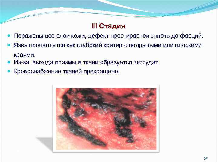 III Стадия Поражены все слои кожи, дефект простирается вплоть до фасций. Язва проявляется как