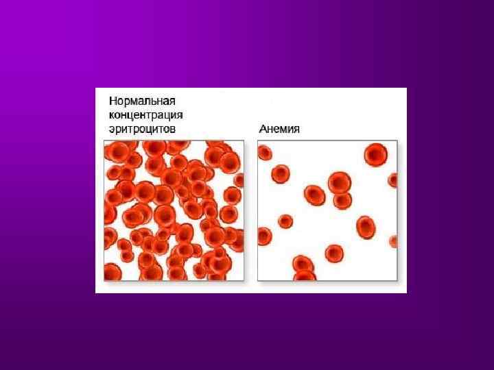 Повышена концентрация эритроцитов. Анемия с нормальным содержанием эритроцитов. Нормальный эритроцит анемия. Эритроцит нормальный и при анемии. Нормальная концентрация эритроцитов и анемия.