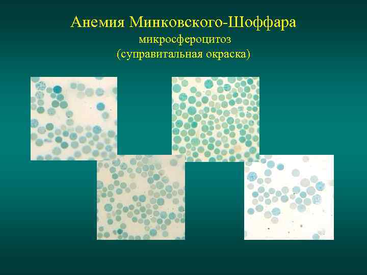 Анемия Минковского-Шоффара микросфероцитоз (суправитальная окраска) 
