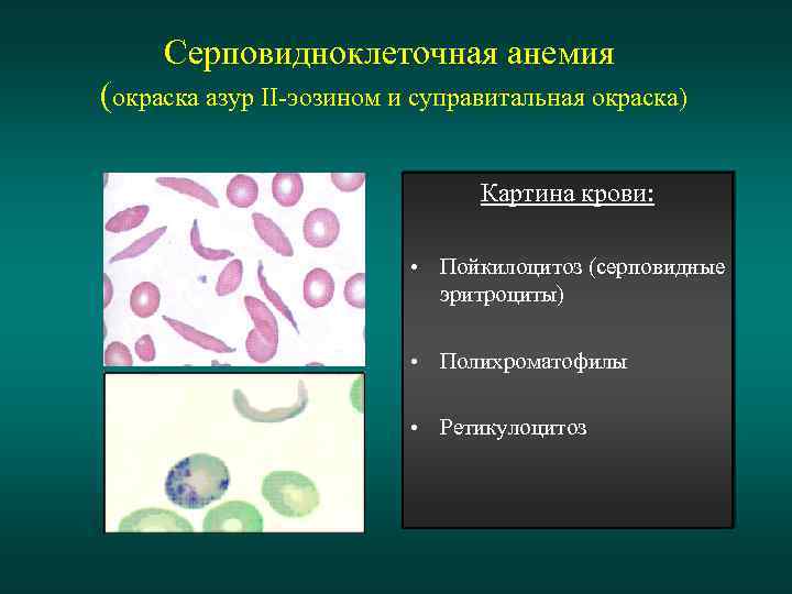 Серповидно клеточная анемия картинки