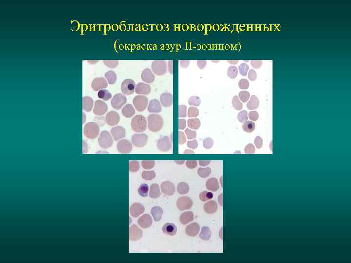 Эритробластоз новорожденных (окраска азур II-эозином) 
