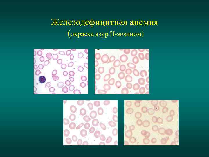 Железодефицитная анемия (окраска азур II-эозином) 