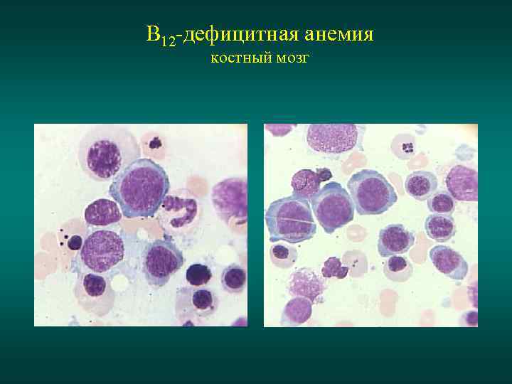В12 фолиеводефицитная анемия картина крови