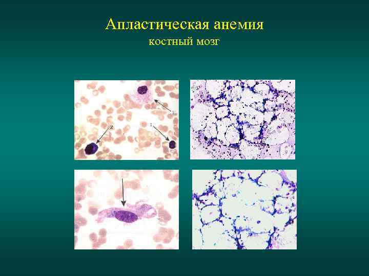 Апластическая анемия костный мозг 