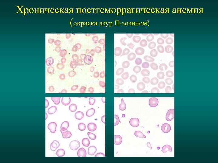 Картина крови при хронической постгеморрагической анемии