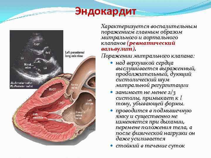 Эндокардит Характеризуется воспалительным поражением главным образом митрального и аортального клапанов (ревматический вальвулит). Поражении митрального