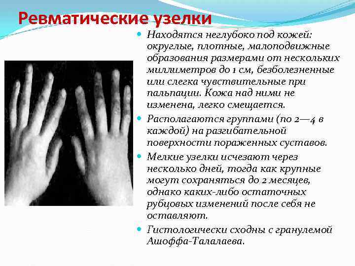 Ревматические узелки Находятся неглубоко под кожей: округлые, плотные, малоподвижные образования размерами от нескольких миллиметров