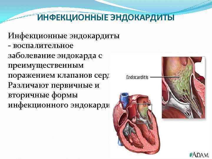 ИНФЕКЦИОННЫЕ ЭНДОКАРДИТЫ Инфекционные эндокардиты - воспалительное заболевание эндокарда с преимущественным поражением клапанов сердца. Различают