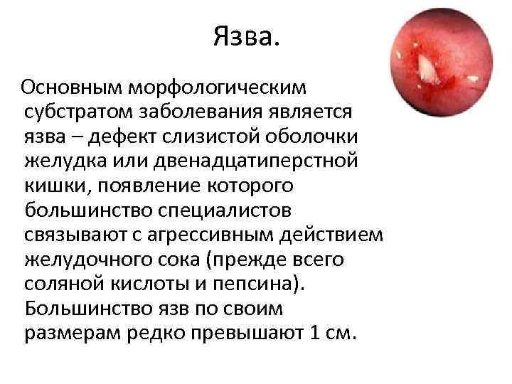 Язва. Основным морфологическим субстратом заболевания является язва – дефект слизистой оболочки желудка или двенадцатиперстной