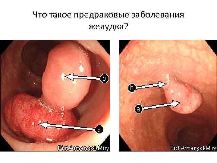 Что такое предраковые заболевания желудка? 