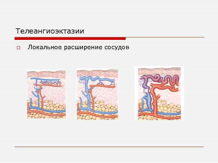 Телеангиоэктазии o Локальное расширение сосудов 