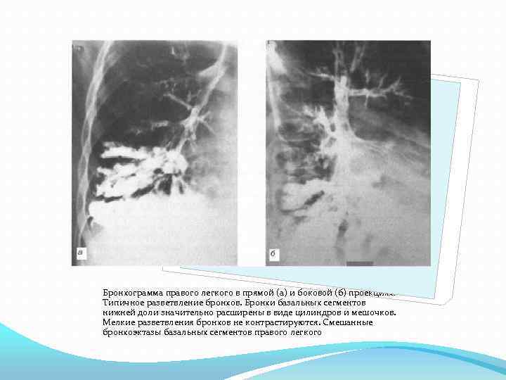 Приобретенные бронхоэктазы