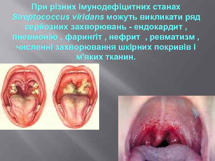 При різних імунодефіцитних станах Streptococcus viridans можуть викликати ряд серйозних захворювань - ендокардит ,