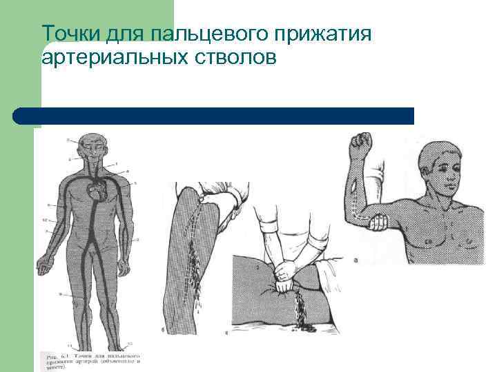 Точки для пальцевого прижатия артериальных стволов 