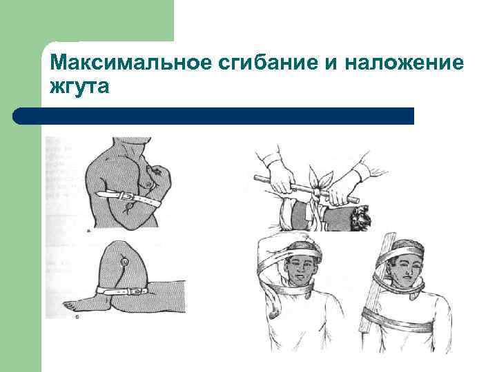 Максимальное сгибание и наложение жгута 