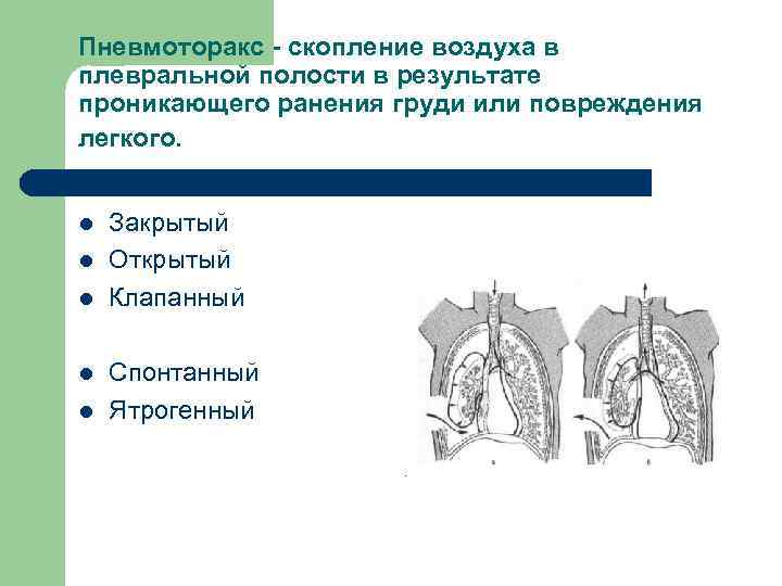 Пневмоторакс - скопление воздуха в плевральной полости в результате проникающего ранения груди или повреждения