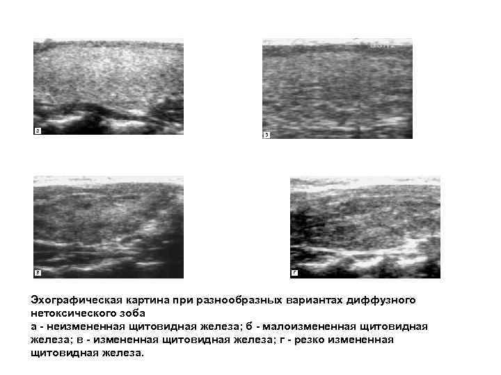 Эхографическая картина при разнообразных вариантах диффузного нетоксического зоба а - неизмененная щитовидная железа; б