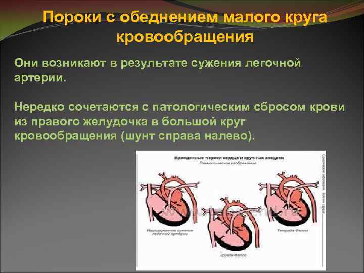 Пороки с обеднением малого круга кровообращения Они возникают в результате сужения легочной артерии. Нередко