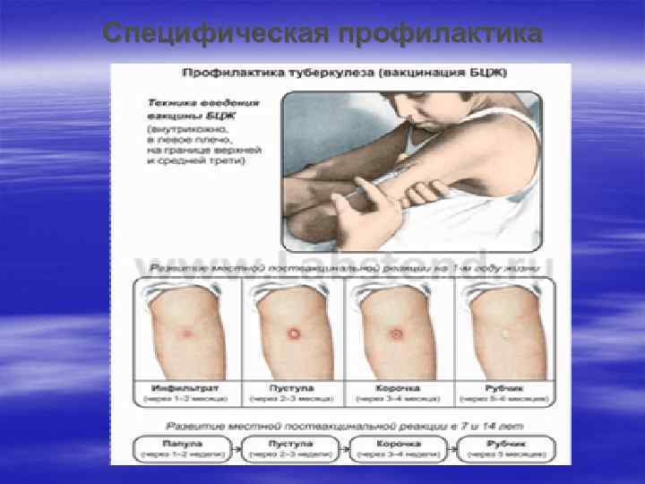 Специфическая профилактика 