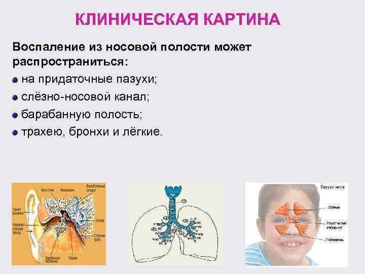 КЛИНИЧЕСКАЯ КАРТИНА Воспаление из носовой полости может распространиться: на придаточные пазухи; слёзно-носовой канал; барабанную