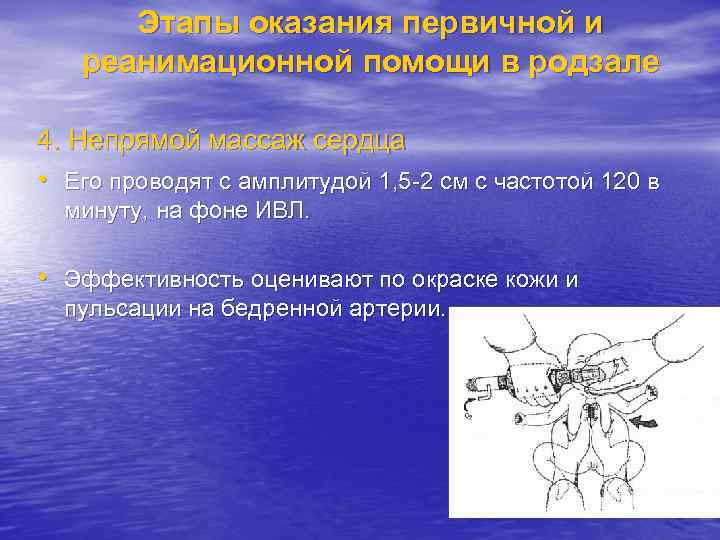 Этапы оказания первичной и реанимационной помощи в родзале 4. Непрямой массаж сердца • Его