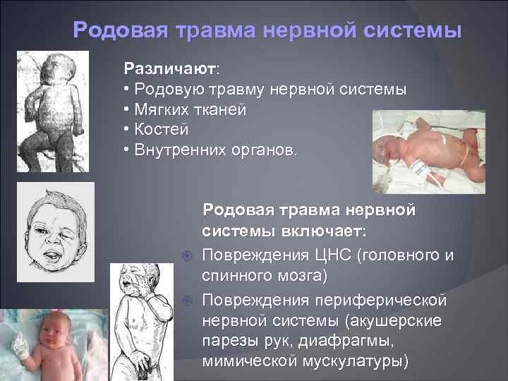 Родовая травма нервной системы Различают: • Родовую травму нервной системы • Мягких тканей •