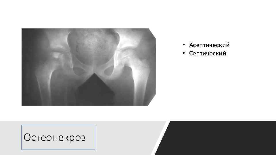  • Асептический • Септический Остеонекроз 