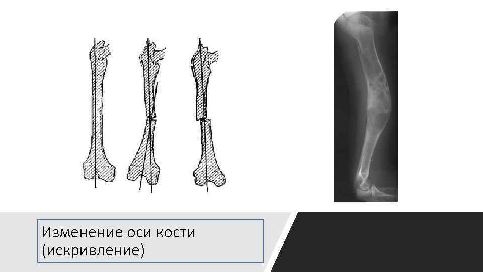 Изменение оси кости (искривление) 