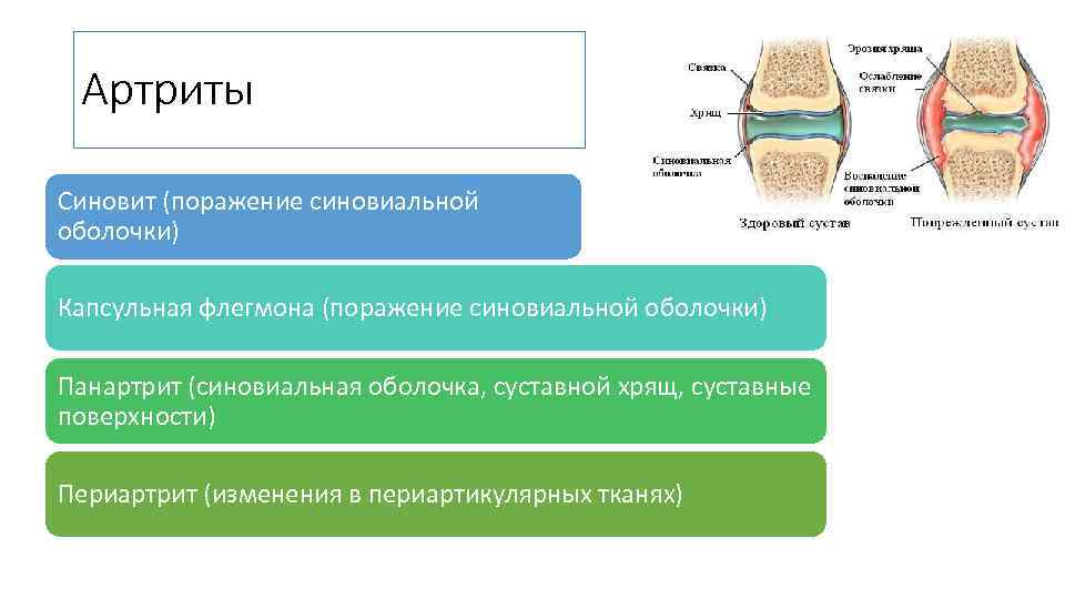 Артриты Синовит (поражение синовиальной оболочки) Капсульная флегмона (поражение синовиальной оболочки) Панартрит (синовиальная оболочка, суставной