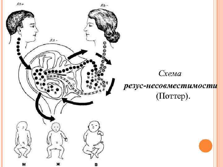 Схема резус-несовместимости (Поттер). 