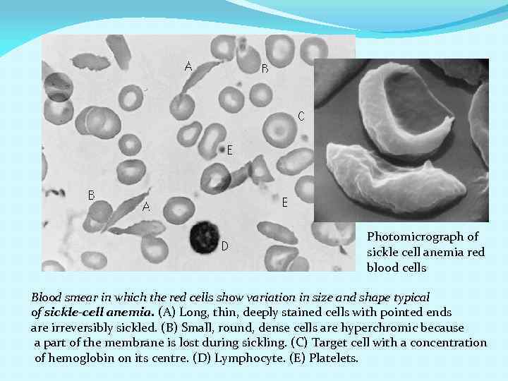 Photomicrograph of sickle cell anemia red blood cells Blood smear in which the red