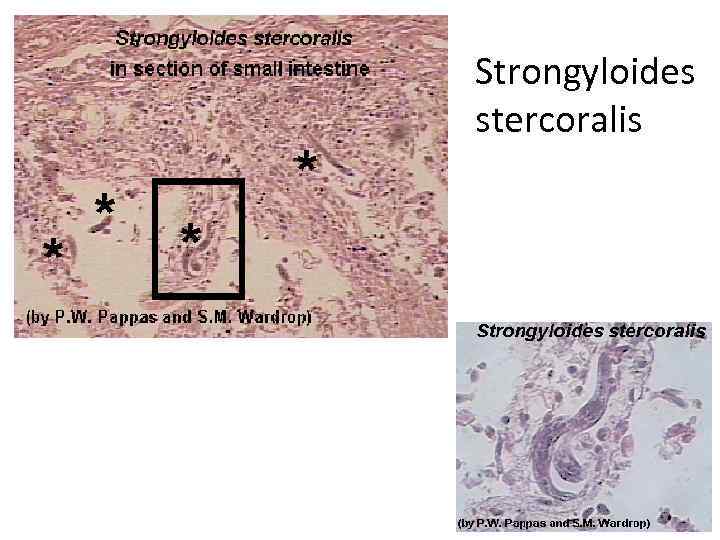 Strongyloides stercoralis 