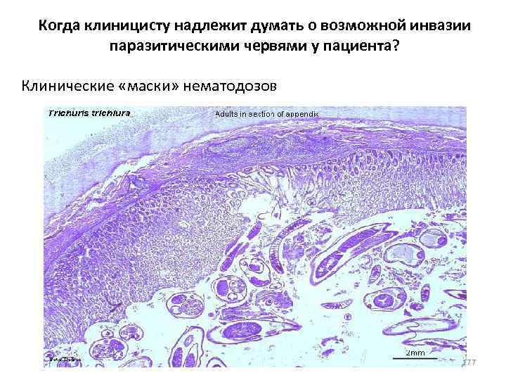 Когда клиницисту надлежит думать о возможной инвазии паразитическими червями у пациента? Клинические «маски» нематодозов