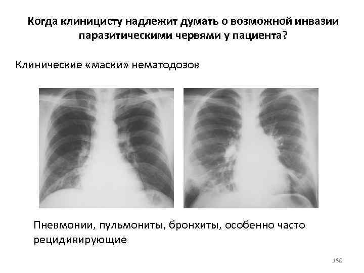 Когда клиницисту надлежит думать о возможной инвазии паразитическими червями у пациента? Клинические «маски» нематодозов