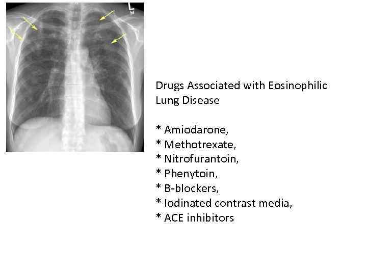 Drugs Associated with Eosinophilic Lung Disease * Amiodarone, * Methotrexate, * Nitrofurantoin, * Phenytoin,