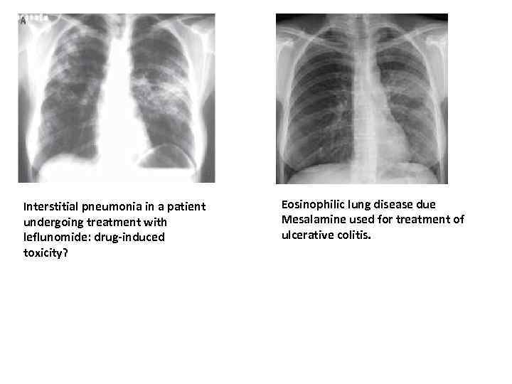 Interstitial pneumonia in a patient undergoing treatment with leflunomide: drug-induced toxicity? Eosinophilic lung disease