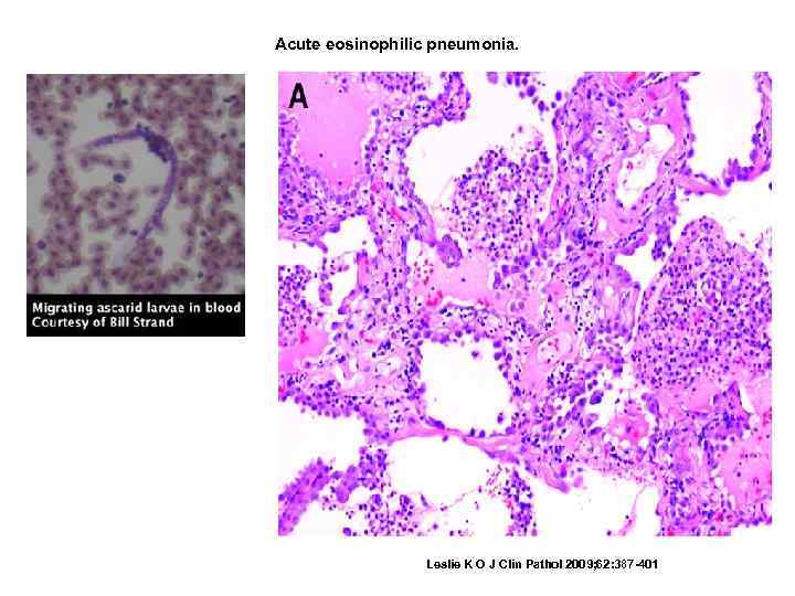 Acute eosinophilic pneumonia. Leslie K O J Clin Pathol 2009; 62: 387 -401 