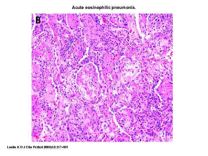 Acute eosinophilic pneumonia. Leslie K O J Clin Pathol 2009; 62: 387 -401 