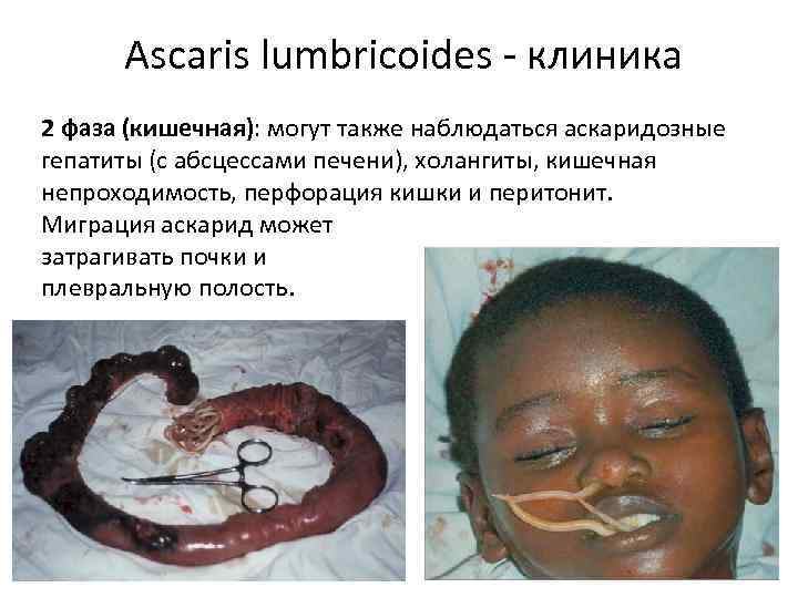 Ascaris lumbricoides - клиника 2 фаза (кишечная): могут также наблюдаться аскаридозные гепатиты (с абсцессами