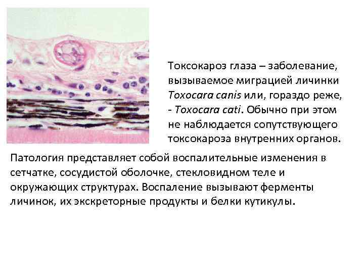 Токсокароз глаза – заболевание, вызываемое миграцией личинки Toxocara canis или, гораздо реже, - Toxocara