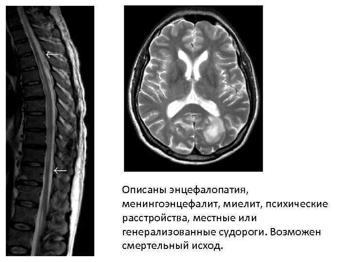 Описаны энцефалопатия, менингоэнцефалит, миелит, психические расстройства, местные или генерализованные судороги. Возможен смертельный исход. 